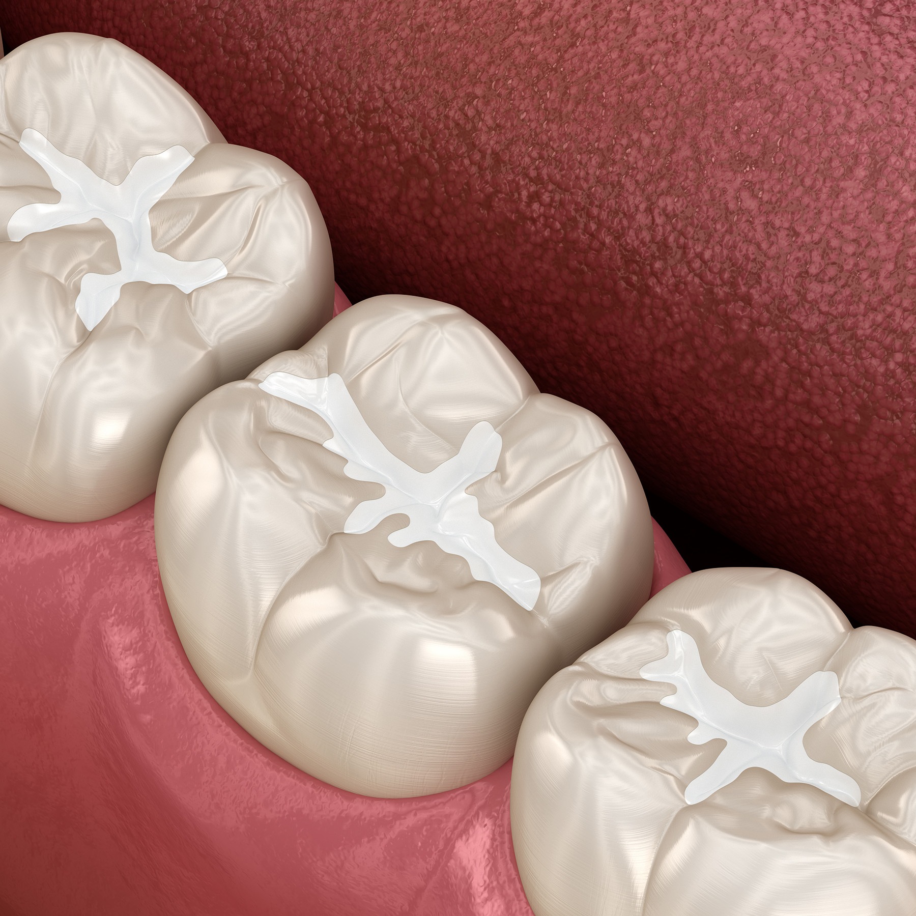 Alt text Digital illustration of a set of upper dentures with a realistic tooth texture, featuring a prominent central incisor and two canine teeth with a white filling design.